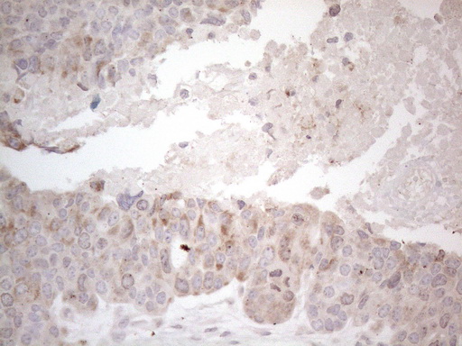 PD-L2 / PDCD1LG2 / CD273 Antibody - Immunohistochemical staining of paraffin-embedded Adenocarcinoma of Human endometrium tissue using anti-PDCD1LG2 mouse monoclonal antibody. (Heat-induced epitope retrieval by 1mM EDTA in 10mM Tris buffer. (pH8.5) at 120°C for 3 min. (1:150).