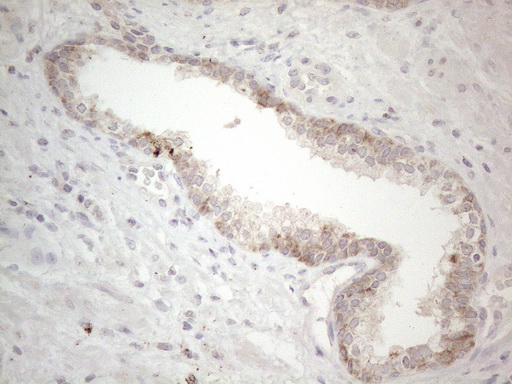 PD-L2 / PDCD1LG2 / CD273 Antibody - Immunohistochemical staining of paraffin-embedded Carcinoma of Human prostate tissue using anti-PDCD1LG2 mouse monoclonal antibody. (Heat-induced epitope retrieval by 1mM EDTA in 10mM Tris buffer. (pH8.5) at 120°C for 3 min. (1:150).