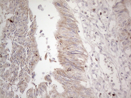 PD-L2 / PDCD1LG2 / CD273 Antibody - Immunohistochemical staining of paraffin-embedded Adenocarcinoma of Human colon tissue using anti-PDCD1LG2 mouse monoclonal antibody. (Heat-induced epitope retrieval by 1mM EDTA in 10mM Tris buffer. (pH8.5) at 120°C for 3 min. (1:150).