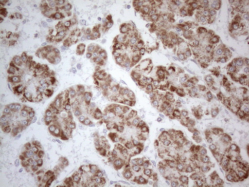 PD-L2 / PDCD1LG2 / CD273 Antibody - Immunohistochemical staining of paraffin-embedded Carcinoma of Human liver tissue using anti-PDCD1LG2 mouse monoclonal antibody. (Heat-induced epitope retrieval by 1mM EDTA in 10mM Tris buffer. (pH8.5) at 120°C for 3 min. (1:150) Dilution: 1:150