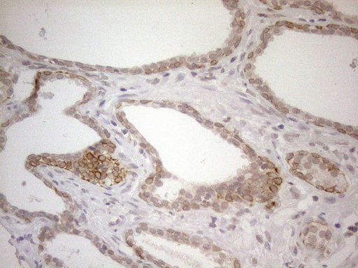 PD-L2 / PDCD1LG2 / CD273 Antibody - Immunohistochemical staining of paraffin-embedded Human prostate tissue within the normal limits using anti-PDCD1LG2 mouse monoclonal antibody. HIER pretreatment was done with 1mM EDTA in 10mM Tris buffer. (pH8.0) at 120°C for 2.5 minutes.was diluted 1:500 and detection was done with HRP secondary and DAB chromogen. Cytoplasmic and membraneous staining seen in tumor cells.