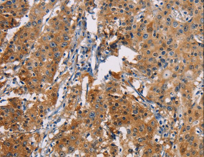 PD-L2 / PDCD1LG2 / CD273 Antibody - Immunohistochemistry of paraffin-embedded Human thyroid cancer using PDCD1LG2 Polyclonal Antibody at dilution of 1:50.
