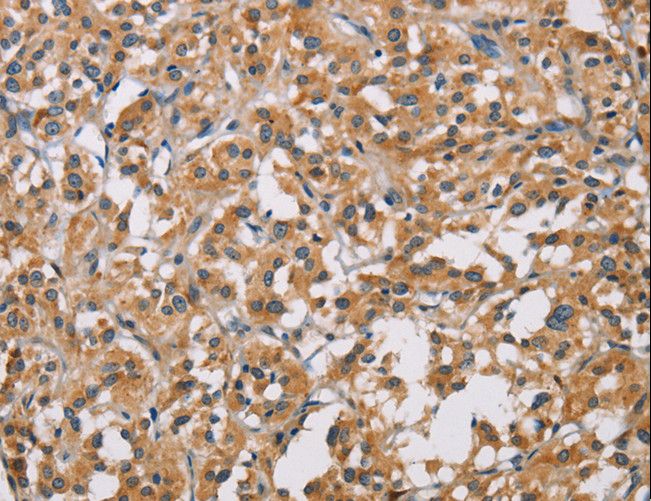 PD-L2 / PDCD1LG2 / CD273 Antibody - Immunohistochemistry of paraffin-embedded Human thyroid cancer using PDCD1LG2 Polyclonal Antibody at dilution of 1:50.