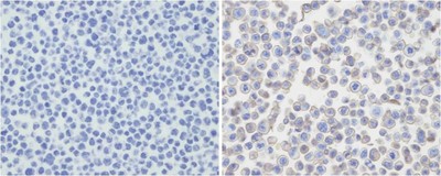 PD-L2 / PDCD1LG2 / CD273 Antibody - Immunohistochemical analysis of PDL-2 in untransfected (left) or transfected (right) with 293T cell sections. Cell was fixed with formaldehyde; antigen retrieval was by heat mediation with a EDTA buffer (pH9. 0). Samples were incubated with primary antibody (1:25) for 1 hours at room temperature. A undiluted biotinylated goat polyvalent antibody was used as the secondary antibody.