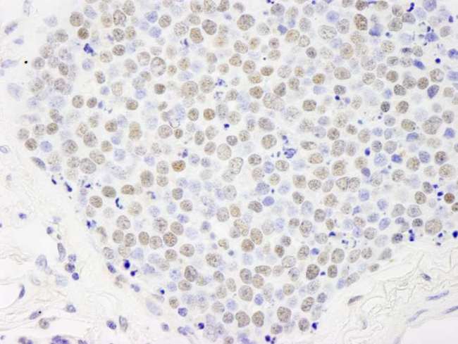 PD2 / PAF1 Antibody - Detection of Human Paf1 by Immunohistochemistry. Sample: FFPE section of human small cell lung cancer. Antibody: Affinity purified rabbit anti-Paf1 used at a dilution of 1:250.