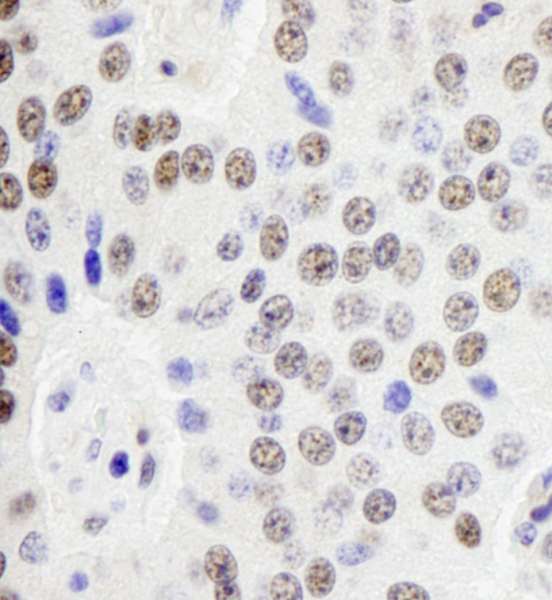 PD2 / PAF1 Antibody - Detection of Human Paf1 by Immunohistochemistry. Sample: FFPE section of human pancreatic islet cell tumor. Antibody: Affinity purified rabbit anti-Paf1 used at a dilution of 1:250.