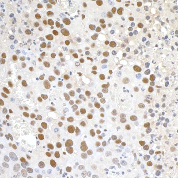 PD2 / PAF1 Antibody - Detection of mouse Paf1 by immunohistochemistry. Sample: FFPE section of mouse renal cell carcinoma. Antibody: Affinity purified rabbit anti-Paf1 used at a dilution of 1:250. Detection: DAB