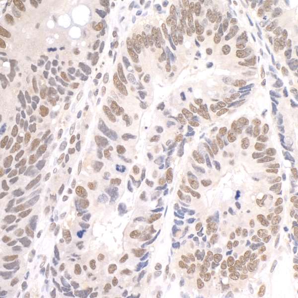 PD2 / PAF1 Antibody - Detection of human Paf1 by immunohistochemistry. Sample: FFPE section of human ovarian carcinoma. Antibody: Affinity purified rabbit anti-Paf1 used at a dilution of 1:250. Detection: DAB