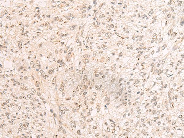 PD2 / PAF1 Antibody - Immunohistochemistry of paraffin-embedded Human liver cancer tissue  using PAF1 Polyclonal Antibody at dilution of 1:45(×200)