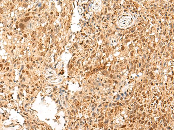 PD2 / PAF1 Antibody - Immunohistochemistry of paraffin-embedded Human cervical cancer tissue  using PAF1 Polyclonal Antibody at dilution of 1:55(×200)