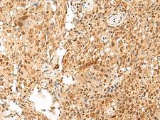 PD2 / PAF1 Antibody - Immunohistochemistry of paraffin-embedded Human cervical cancer tissue  using PAF1 Polyclonal Antibody at dilution of 1:55(×200)