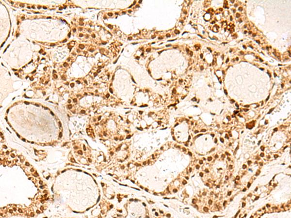 PD2 / PAF1 Antibody - Immunohistochemistry of paraffin-embedded Human thyroid cancer tissue  using PAF1 Polyclonal Antibody at dilution of 1:55(×200)