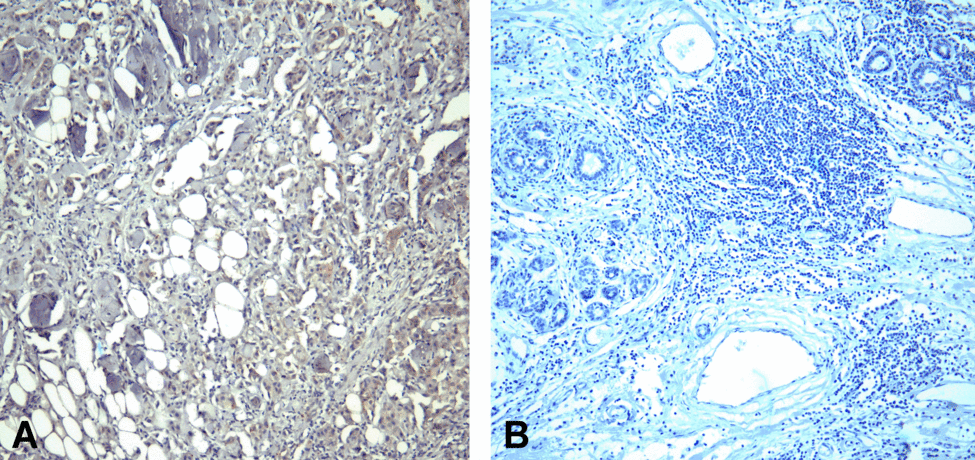 PDCD1 / CD279 / PD-1 Antibody - (A) Immunohistochemistry of PD-1 in human breast cancer tissue with PD-1 [10B3] antibody at 10 ug/mL. (B) Immunohistochemistry in human breast cancer tissue with control mouse IgG staining at 10 ug/mL.