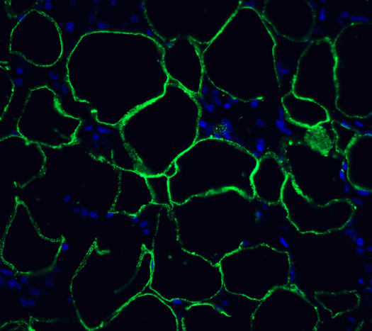 PDCD1 / CD279 / PD-1 Antibody - Immunofluorescence of PD-1 in human breast cancer tissue with PD-1 [4C7] antibody at 10 ug/mL. Green: PD1 Antibody [4C7] Blue: DAPI staining