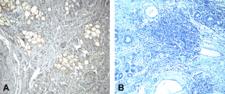 PDCD1 / CD279 / PD-1 Antibody - (A) Immunohistochemistry of PD-1 in human breast cancer tissue with PD-1 [4C7] antibody at 10 ug/mL. (B) Immunohistochemistry in human breast cancer tissue with control mouse IgG staining at 10 ug/mL.