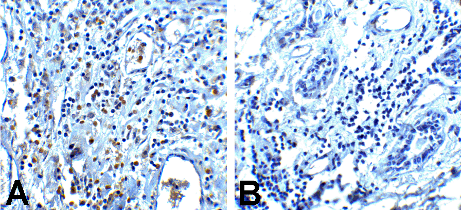 PDCD1 / CD279 / PD-1 Antibody - Immunohistochemistry of PD-1 in (A) human breast cancer tissue and (B) human normal breast tissue with PD-1 antibody at 5 ug/mL.