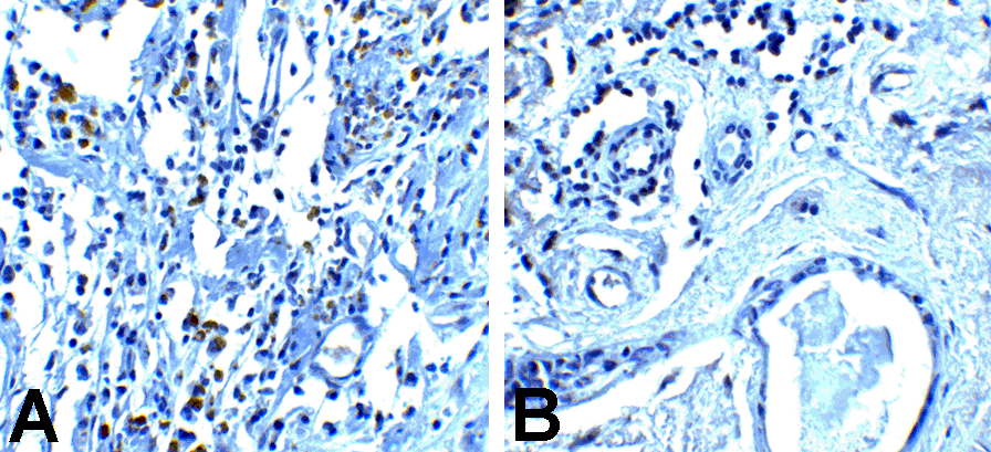 PDCD1 / CD279 / PD-1 Antibody - Immunohistochemistry of PD-1 in (A) human breast cancer tissue and (B) human normal breast tissue with PD-1 antibody at 5 ug/mL.