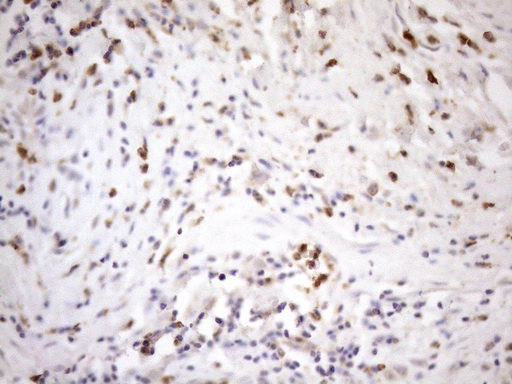 PDCD1 / CD279 / PD-1 Antibody - Immunohistochemical staining of paraffin-embedded Carcinoma of Human bladder tissue using anti-PDCD1 mouse monoclonal antibody. (Heat-induced epitope retrieval by 1mM EDTA in 10mM Tris buffer. (pH8.5) at 120°C for 3 min. (1:150)