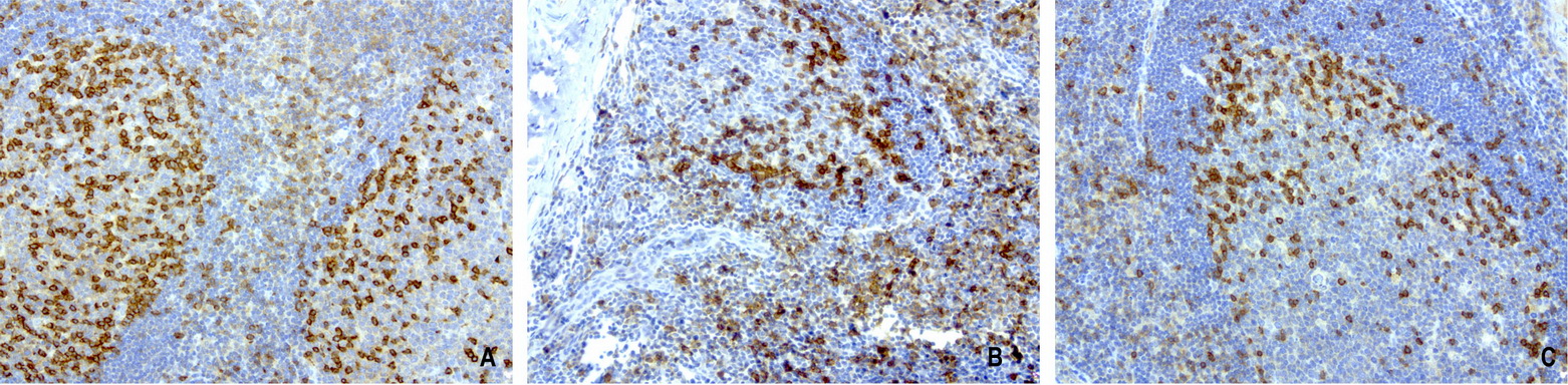PDCD1 / CD279 / PD-1 Antibody - Immunohistochemical staining of 3 cases of paraffin-embedded human tonsil using anti-PD-1 clone UMAB198 mouse monoclonal antibody  at 1:800 with Polink2 Broad HRP DAB detection kit; heat-induced epitope retrieval with GBI Accel pH8.7 HIER buffer using pressure chamber for 3 minutes at 110C. Very strong cytoplasmic and membraneous staining in the activated Tcells of tonsil.