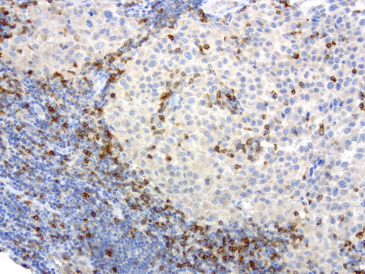 PDCD1 / CD279 / PD-1 Antibody - Immunohistochemical staining of paraffin-embedded human melanoma using anti-PD-1 clone UMAB198 mouse monoclonal antibody  at 1:800 with Polink2 Broad HRP DAB detection kit; heat-induced epitope retrieval with GBI Accel pH8.7 HIER buffer using pressure chamber for 3 minutes at 110C. Very strong cytoplasmic and membraneous staining in the activated Tcells no staining on the tumor.
