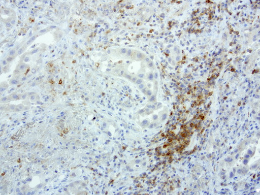 PDCD1 / CD279 / PD-1 Antibody - Immunohistochemical staining of paraffin-embedded human lung cancer using anti-PD-1 clone UMAB198 mouse monoclonal antibody  at 1:800 with Polink2 Broad HRP DAB detection kit; heat-induced epitope retrieval with GBI Accel pH8.7 HIER buffer using pressure chamber for 3 minutes at 110C. Very strong cytoplasmic and membraneous staining in the activated Tcells no staining on the tumor.