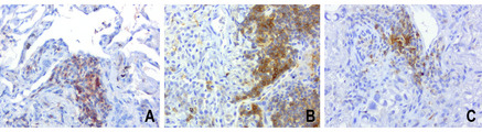 PDCD1 / CD279 / PD-1 Antibody - Immunohistochemical staining of 3 paraffin-embedded human lung carcinomas using anti-PD1 clone UMAB199 mouse monoclonal antibody at 1:800 requires HIER Accel [OriGene/GBI Labs B22-125] in Pressure Chamber for 3 minute on high. Detection of primary antibody was achieved with Polink2 Broad HRP DAB [OriGene/GBI Labs D22].