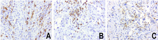 PDCD1 / CD279 / PD-1 Antibody - Immunohistochemical staining of paraffin-embedded human melanoma using anti-PD-1 clone UMAB199 mouse monoclonal antibody at 1:800 dilution of 1mg/mL and detection with Polink2 Broad HRP DAB.requires heat-induced epitope retrieval with Accel for 3minutes at110C in pressure chamber. The composite image of 3 melanoma shows the tumor cells are negative for PD-1 however the activated TCells show strong membranous and cytoplasmic staining.