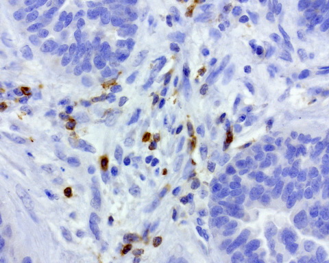 PDCD1 / CD279 / PD-1 Antibody - Immunohistochemical staining of paraffin-embedded human ovarian carcinoma using anti-PD-1 clone UMAB199 mouse monoclonal antibody at 1:800 dilution of 1mg/mL and detection with Polink2 Broad HRP DAB.requires heat-induced epitope retrieval with Accel for 3minutes at110C in pressure chamber. The image shows the tumor cells are negative for PD-1 however the activated TCells show strong membranous and cytoplasmic staining.