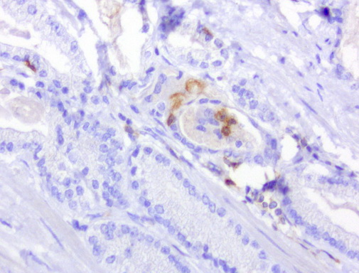 PDCD1 / CD279 / PD-1 Antibody - Immunohistochemical staining of paraffin-embedded human prostate carcinoma using anti-PD-1 clone UMAB199 mouse monoclonal antibody at 1:800 dilution of 1mg/mL and detection with Polink2 Broad HRP DAB.requires heat-induced epitope retrieval with Accel for 3minutes at110C in pressure chamber. The image shows the tumor cells are negative for PD-1 however the activated TCells show strong membranous and cytoplasmic staining.