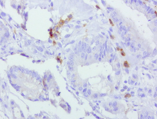 PDCD1 / CD279 / PD-1 Antibody - Immunohistochemical staining of paraffin-embedded human colon cancer using anti-PD-1 clone UMAB199 mouse monoclonal antibody at 1:800 dilution of 1mg/mL and detection with Polink2 Broad HRP DAB.requires heat-induced epitope retrieval with Accel for 3minutes at110C in pressure chamber. The image shows the tumor cells are negative for PD-1 however the activated TCells show strong membranous and cytoplasmic staining.