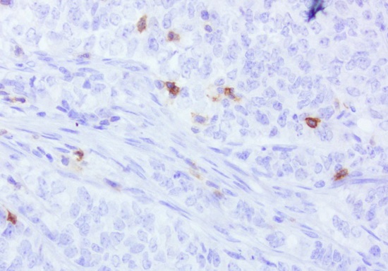 PDCD1 / CD279 / PD-1 Antibody - Immunohistochemical staining of paraffin-embedded human endometrial cancer using anti-PD-1 clone UMAB199 mouse monoclonal antibody at 1:800 dilution of 1mg/mL and detection with Polink2 Broad HRP DAB.requires heat-induced epitope retrieval with Accel for 3minutes at110C in pressure chamber. The image shows the tumor cells are negative for PD-1 however the activated TCells show strong membranous and cytoplasmic staining.