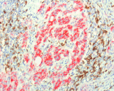 PDCD1 / CD279 / PD-1 Antibody - Sequential double staining of paraffin human lung using anti-b-Catenin(red) and anti-PD1(brown). Both antibodies at 1:800 dilution of 1mg/mL. Anti-PD1: heat-induced epitope retrieval with Accel; anti-b-Catenin: citrate pH6.0. Image shows tumor cells are strongly positve for b-catenin. (red) and negative for PD1. The arrows point to the activated T cells. (brown) showing strong membranous and cytoplasmic staining of PD1 and no staining with b-catenin.