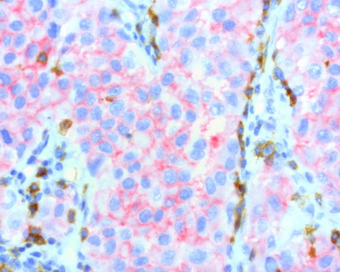 PDCD1 / CD279 / PD-1 Antibody - Sequential double staining of paraffin human melanoma using b-catenin(red) and PD1(brown). Both abs at 1:800 dilution of 1mg/mL; detection with Polink2 HRP DAB followed by Polink2 Broad AP. Anti-PD1: heat-induced epitope retrieval with Accel; anti-b-catenin: citrate pH6.0. Image shows tumor cells are strongly positve for b-catenin. (red) and negative for PD1. The activated T cells. (brown) show strong membranous and cytoplasmic staining for PD1 and no staining with b-catenin.