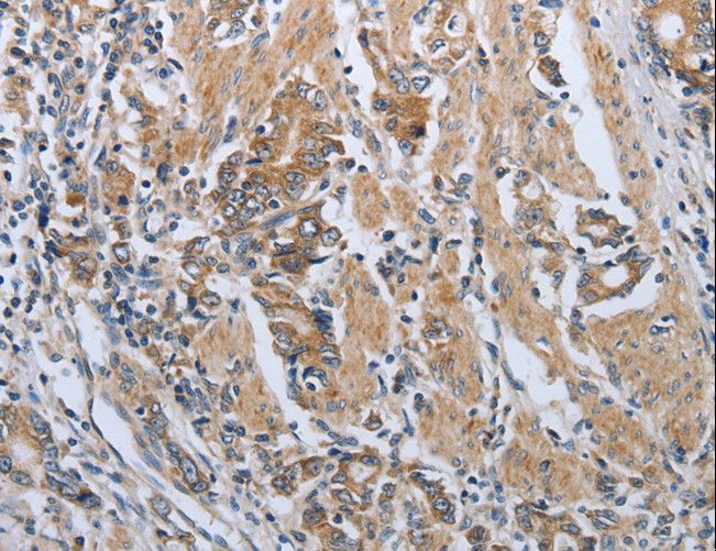 PDCD1 / CD279 / PD-1 Antibody - Immunohistochemistry of paraffin-embedded Human lung cancer using PDCD1 Polyclonal Antibody at dilution of 1:50.