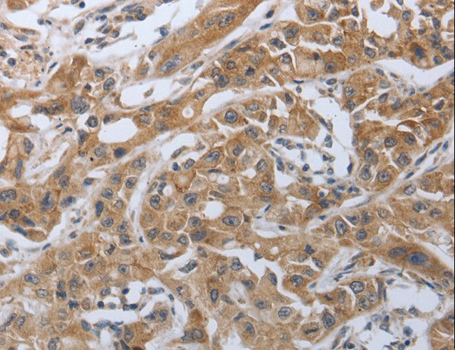 PDCD1 / CD279 / PD-1 Antibody - Immunohistochemistry of paraffin-embedded Human lung cancer using PDCD1 Polyclonal Antibody at dilution of 1:50.
