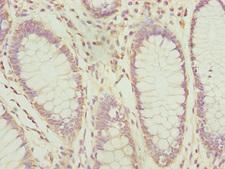 PDCD2L Antibody - Immunohistochemistry of paraffin-embedded human colon cancer at dilution 1:100