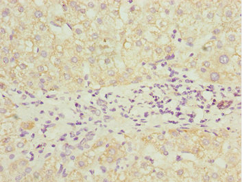 PDCD2L Antibody - Immunohistochemistry of paraffin-embedded human liver cancer at dilution 1:100
