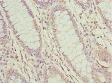 PDCD2L Antibody - Immunohistochemistry of paraffin-embedded human colon cancer at dilution 1:100