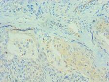 PDCD4 Antibody - Immunohistochemistry of paraffin-embedded human breast cancer using antibody at 1:100 dilution.