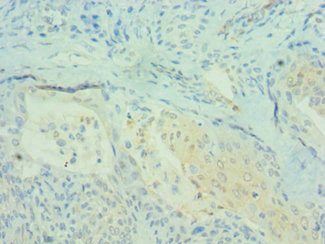 PDCD4 Antibody - Immunohistochemistry of paraffin-embedded human breast cancer using PDCD4 Antibody at dilution of 1:100