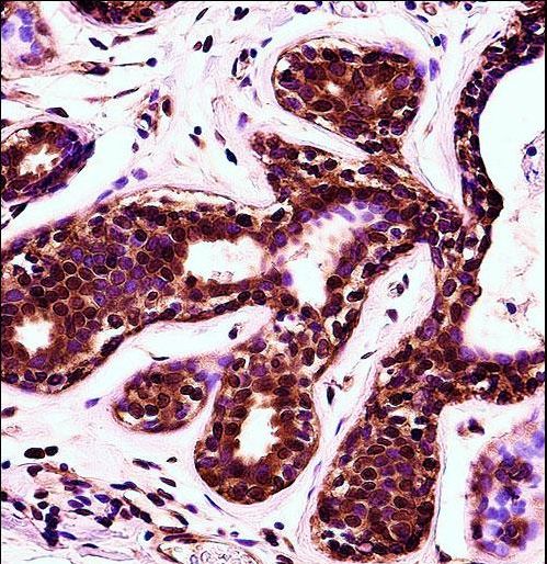 PDCD4 Antibody - PDCD4 Antibody immunohistochemistry of formalin-fixed and paraffin-embedded human breast tissue followed by peroxidase-conjugated secondary antibody and DAB staining.