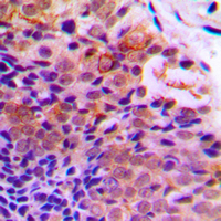 PDCD4 Antibody - Immunohistochemical analysis of PDCD4 (pS457) staining in human prostate cancer formalin fixed paraffin embedded tissue section. The section was pre-treated using heat mediated antigen retrieval with sodium citrate buffer (pH 6.0). The section was then incubated with the antibody at room temperature and detected using an HRP conjugated compact polymer system. DAB was used as the chromogen. The section was then counterstained with hematoxylin and mounted with DPX.