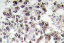 PDCD4 Antibody - IHC of PDCD4 (K453) pAb in paraffin-embedded human breast carcinoma tissue.