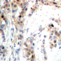 PDCD4 Antibody - Immunohistochemical analysis of PDCD4 (pS67) staining in human prostate cancer formalin fixed paraffin embedded tissue section. The section was pre-treated using heat mediated antigen retrieval with sodium citrate buffer (pH 6.0). The section was then incubated with the antibody at room temperature and detected using an HRP conjugated compact polymer system. DAB was used as the chromogen. The section was then counterstained with hematoxylin and mounted with DPX.