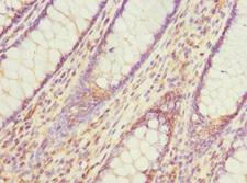 PDCD5 Antibody - Immunohistochemistry of paraffin-embedded human colon cancer at dilution 1:100