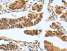 PDCD5 Antibody - Immunohistochemistry of paraffin-embedded Human colorectal cancer tissue  using PDCD5 Polyclonal Antibody at dilution of 1:55(×200)