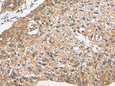 PDCD5 Antibody - Immunohistochemistry of paraffin-embedded Human esophagus cancer tissue  using PDCD5 Polyclonal Antibody at dilution of 1:105(×200)