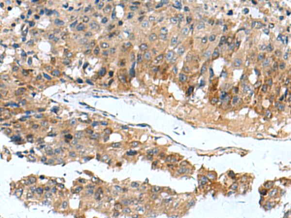 PDCD5 Antibody - Immunohistochemistry of paraffin-embedded Human liver cancer tissue  using PDCD5 Polyclonal Antibody at dilution of 1:105(×200)