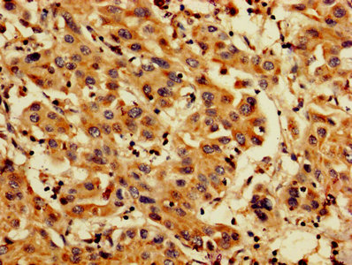 PDCD6 / ALG-2 Antibody - IHC image of PDCD6 Antibody diluted at 1:200 and staining in paraffin-embedded human liver cancer performed on a Leica BondTM system. After dewaxing and hydration, antigen retrieval was mediated by high pressure in a citrate buffer (pH 6.0). Section was blocked with 10% normal goat serum 30min at RT. Then primary antibody (1% BSA) was incubated at 4°C overnight. The primary is detected by a biotinylated secondary antibody and visualized using an HRP conjugated SP system.