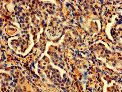 PDCD6 / ALG-2 Antibody - IHC image of PDCD6 Antibody diluted at 1:200 and staining in paraffin-embedded human lung cancer performed on a Leica BondTM system. After dewaxing and hydration, antigen retrieval was mediated by high pressure in a citrate buffer (pH 6.0). Section was blocked with 10% normal goat serum 30min at RT. Then primary antibody (1% BSA) was incubated at 4°C overnight. The primary is detected by a biotinylated secondary antibody and visualized using an HRP conjugated SP system.